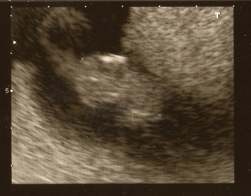 The blurriest ultrasound image ever. Trust me. It's a fetus. A fetus with a very good heartbeat.